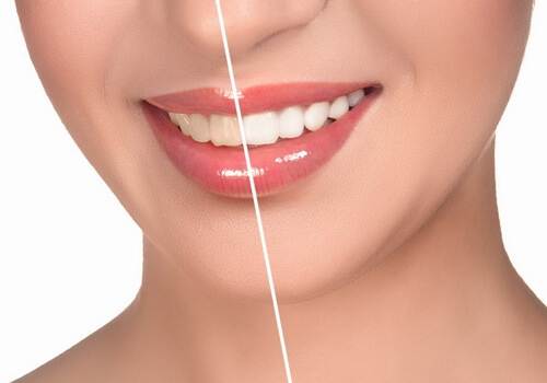 офисное отбеливание в минске