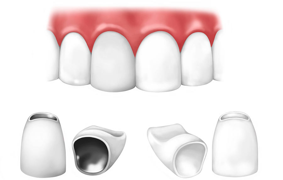 Зубы из металлокерамики