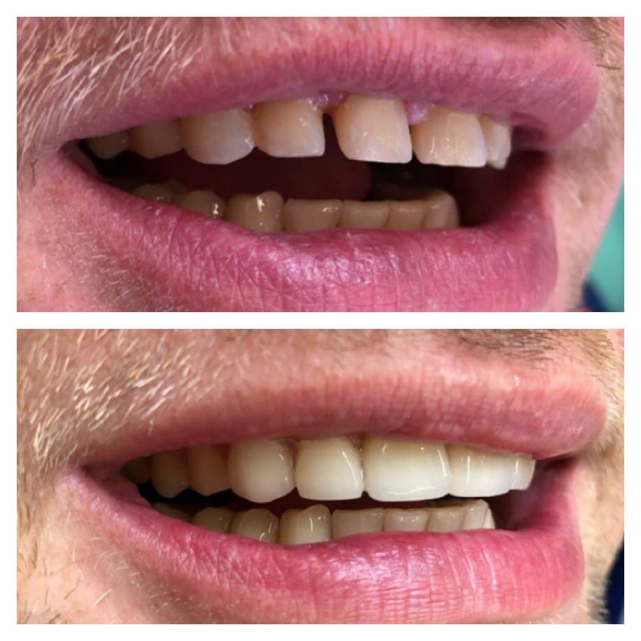 виниры на зубы в минске