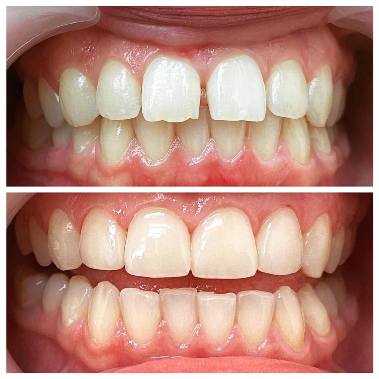 установка виниров