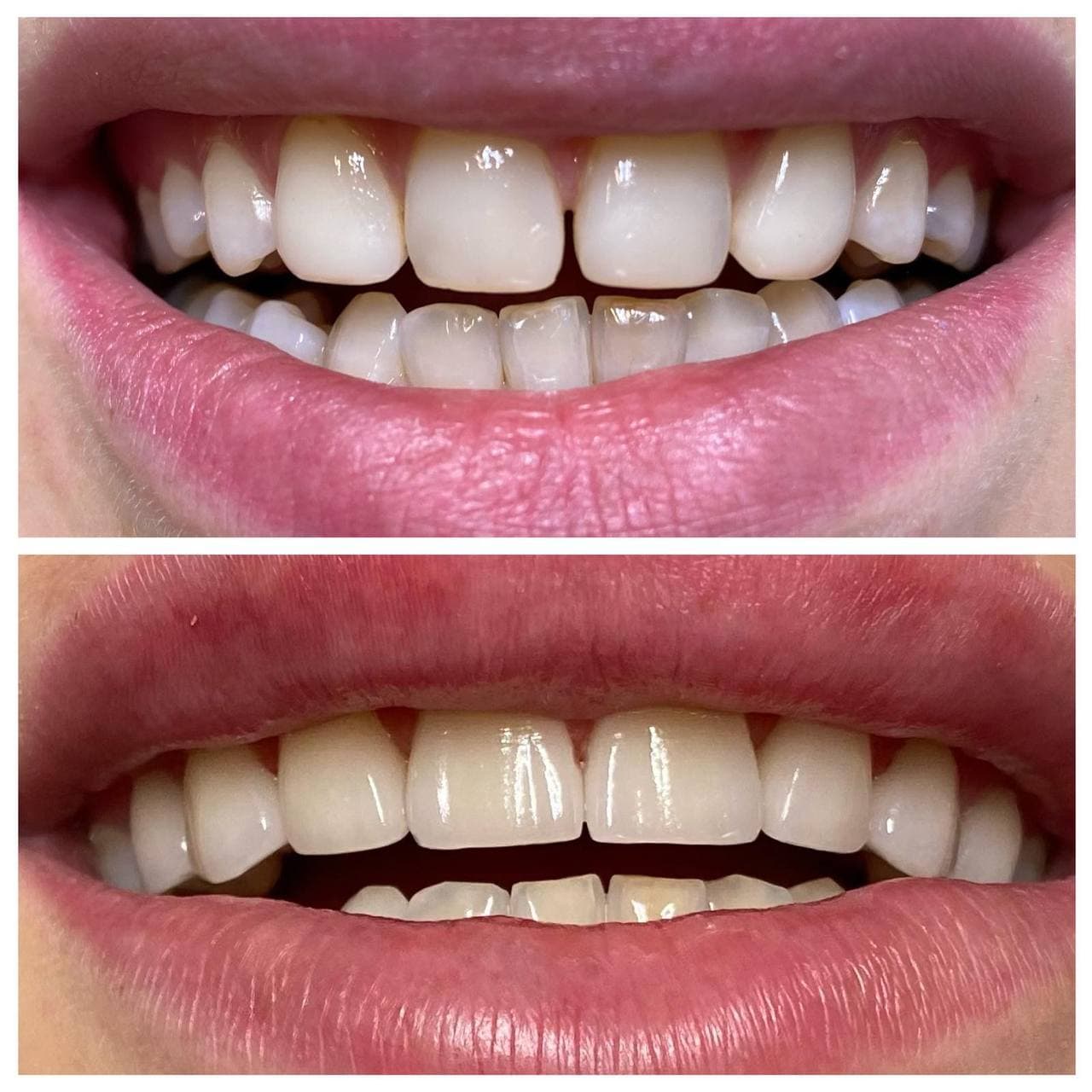 установка виниров в минске