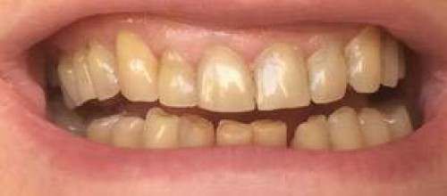 Эстетическая реставрация передних зубов