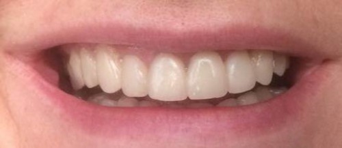 Эстетическая реставрация передних зубов