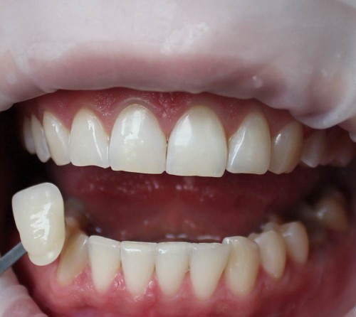 Отбеливание зубов в Минске