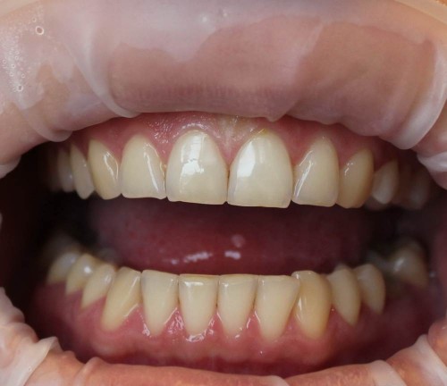 Отбеливание зубов в Минске