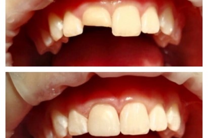 Композитные виниры