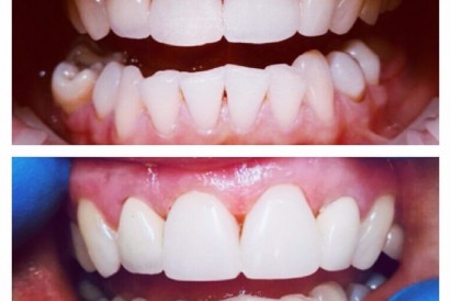 Композитные виниры