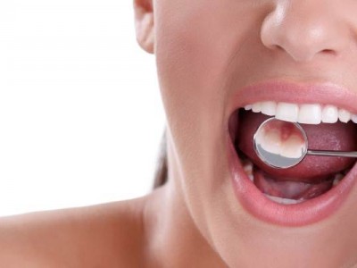 Лечение рецессии десны в Минске Лечение рецессии десны в Минске