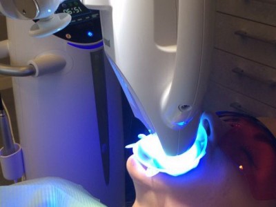 Фотоотбеливание зубов