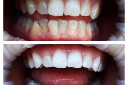 Фотоотбеливание зубов