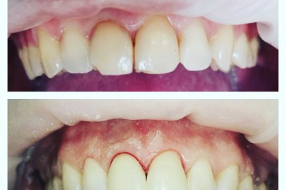 Композитные виниры