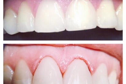 Композитные виниры