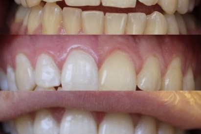 Фотоотбеливание зубов