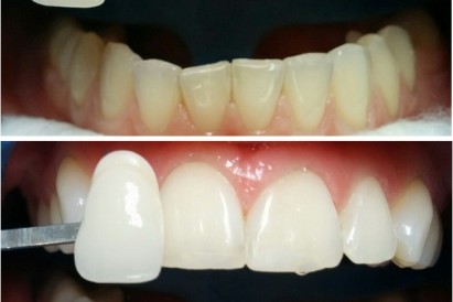 Фотоотбеливание зубов