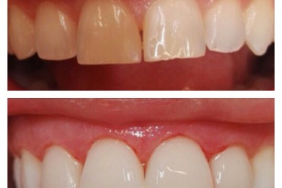 Композитные виниры