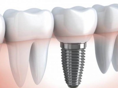 Имплантация зубов в Минске