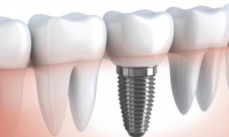 Имплантация зубов в Минске Имплантация зубов в Минске