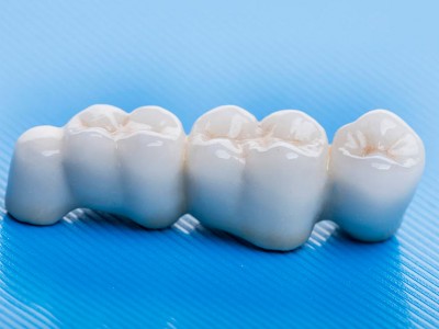 Металлокерамическая коронка Металлокерамическая коронка