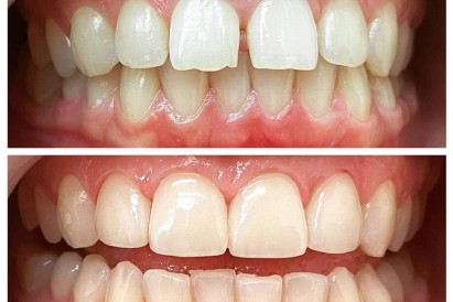 Фотоотбеливание зубов