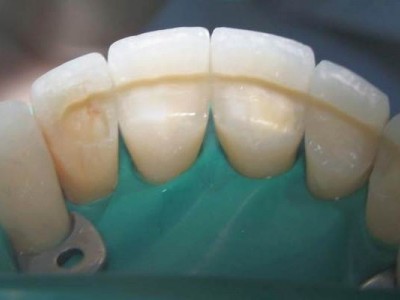 Шинирование зубов Шинирование зубов