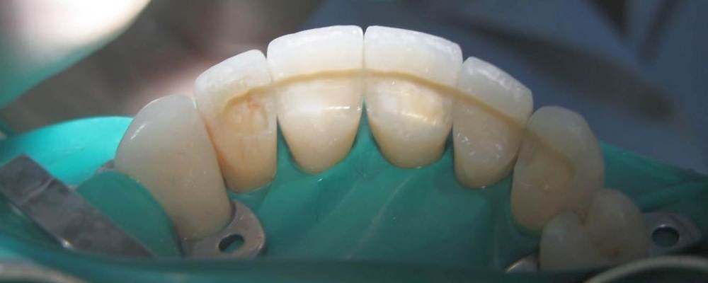Преимущества шинирования зубов