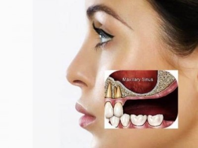 Синус-лифтинг