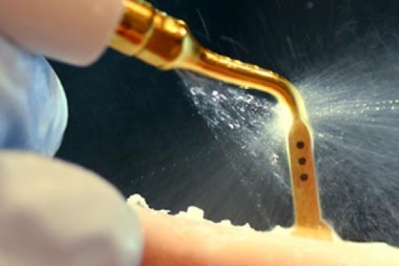 Пьезохирургия в стоматологии