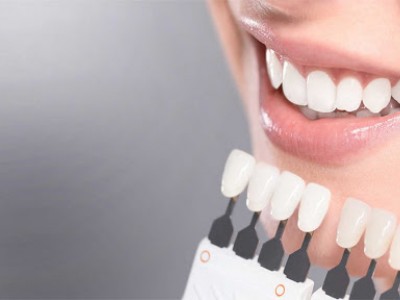 Композитные виниры