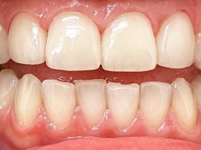 Виниры на зубы Виниры на зубы
